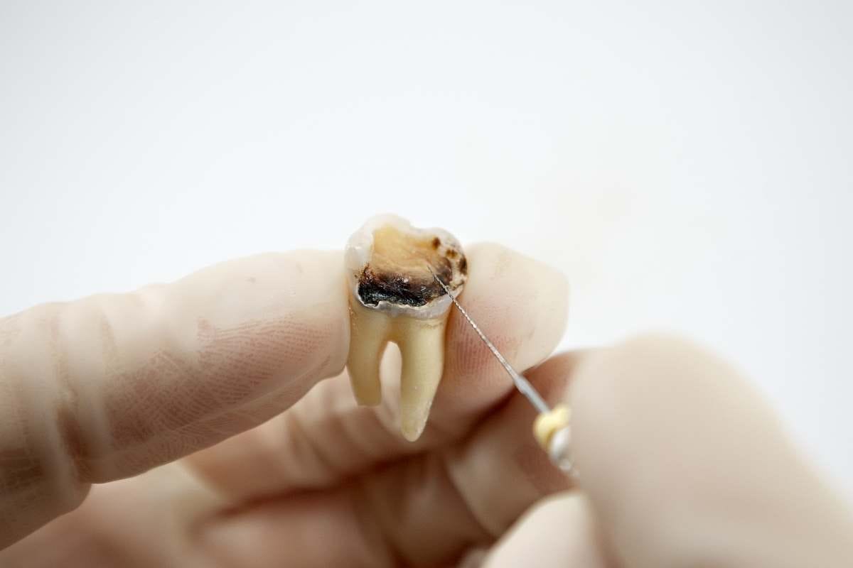 Endodonti Tedavi Acı Verir Mi Endodonti Tedavi Acı Verir Mi