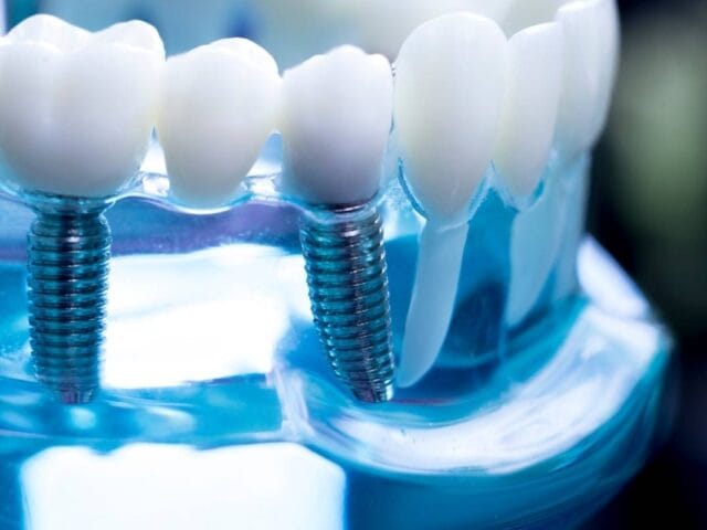 Monoblok İmplant Nedir? Avantajları ve Uygulama Süreci