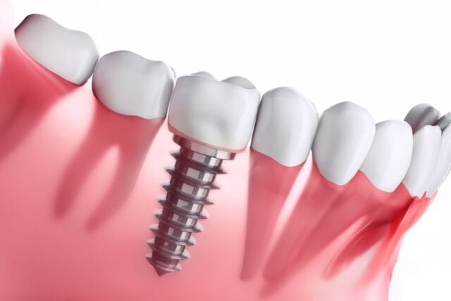 Subperiostal İmplant