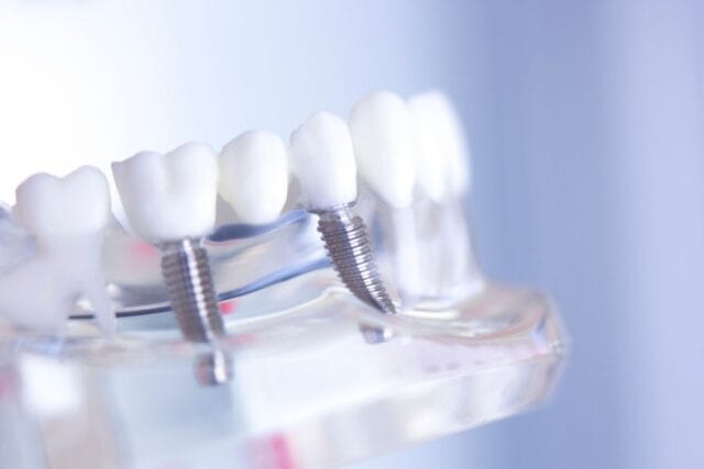 Subperiostal İmplant Kimlere Uygulanır