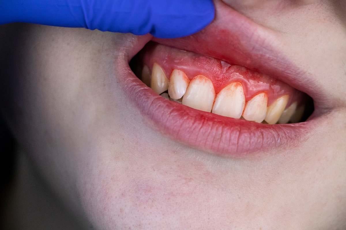 Periodontoloji Ne Yapar Periodontoloji Ne Yapar
