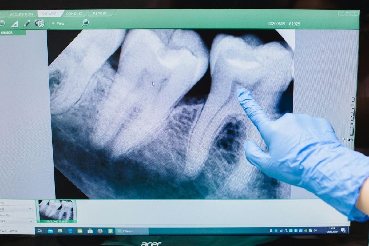 Restoratif Diş Tedavisi Nasıl Yapılır https://atapera.com/wp-content/uploads/2025/05/Restoratif-Dis-Tedavisi-Nasil-Yapilir.jpg